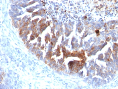 FFPE human ovarian carcinoma sections stained with 100 ul anti-TAG-72 / CA72.4 (clone B72.3 + CC49) at 1:300. HIER epitope retrieval prior to staining was performed in 10mM Citrate, pH 6.0.